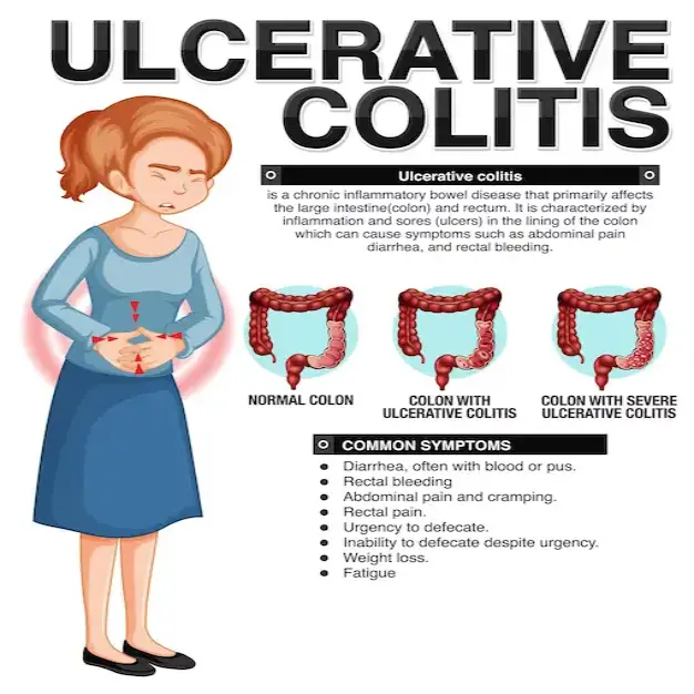 Living with Ulcerative Colitis Infographic - Canadian Digestive Health  Foundation