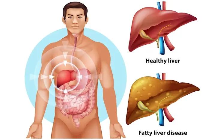 Life Expectancy with Fatty Liver Disease